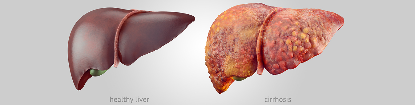 Cirrhosis: What is scarring your liver?